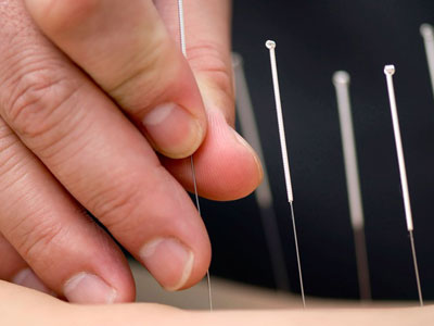 acupuncture-Wellington-Florida-Team-acupuncture