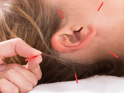acupuncture-Wellington-Florida-Team-acupuncture